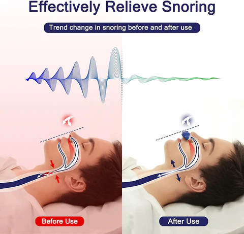 "Kompakt mikro CPAP-enhet i blått, rødt eller hvitt for snorking, laget av medisinsk silikon, ideell for reiser."